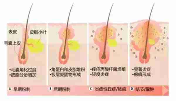 鼻子有痘坑怎么办（鼻子凹坑最难治）