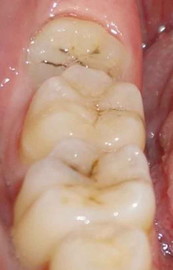 智齿是什么智齿有哪些危害
