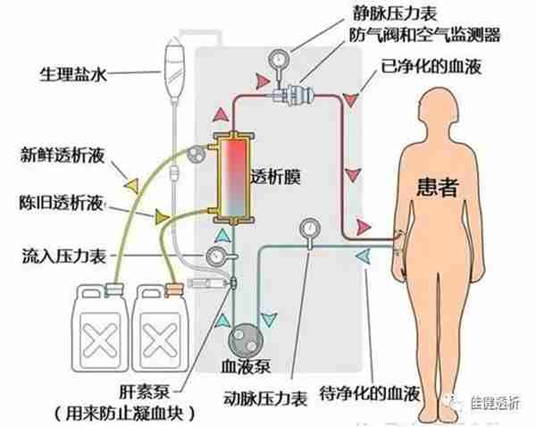 什么是血液透析，血液透析的原理是什么？