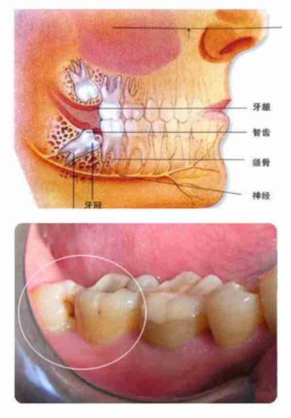 什么是智齿？为什么会长智齿？它有什么危害？一定要拔掉吗？
