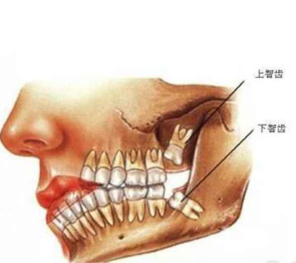 智齿是什么（智齿有哪些危害）