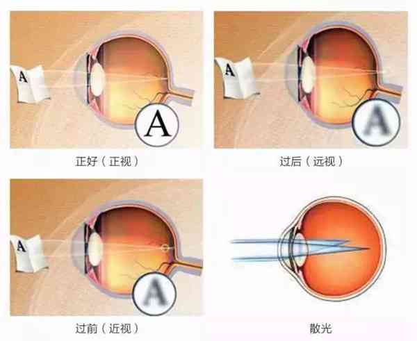 8大近视常见问题，全球父母都在关注，收藏起来吧