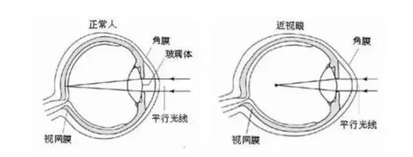 8大近视常见问题，全球父母都在关注，收藏起来吧