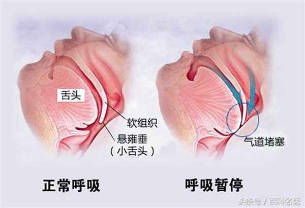 打呼噜是不是一种疾病？打呼噜是什么原因引起的？