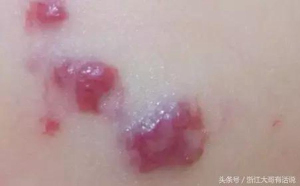 宝宝血管瘤危害家长知多少？血管瘤治疗什么时候好？